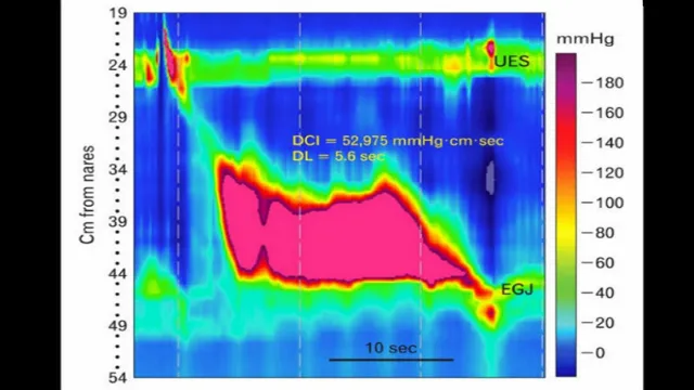 how rare is jackhammer esophagus