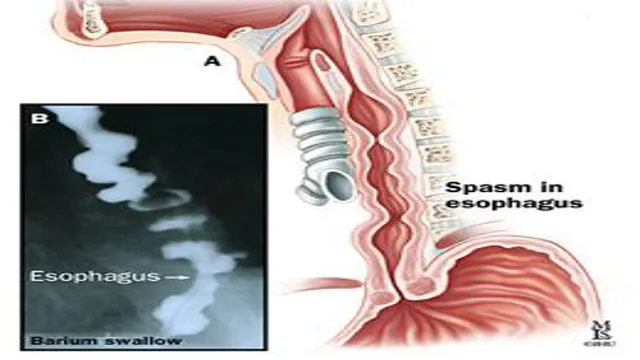 what does jackhammer esophagus feel like